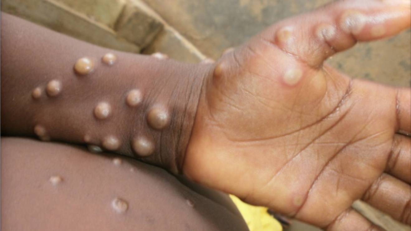 Mpox patient. PHOTO/COURTESY